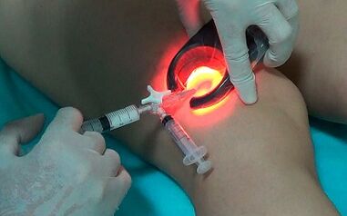 skleroterapia ako spôsob liečby kŕčových žíl na nohách